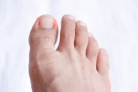What About Infected Ingrown Toenails?