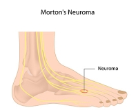 Where Does Morton’s Neuroma Produce Pain?