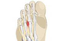 Foot Pain Caused by Morton’s Neuroma