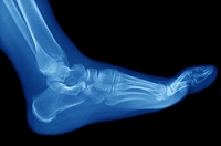 How to Recover From a Foot Stress Fracture
