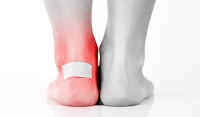 How to Minimize the Impact of Foot Blisters