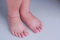 Swollen Feet Is a Normal Part of Pregnancy