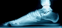 Can Flat Feet Cause Foot Pain?