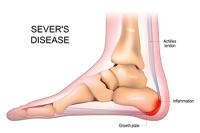 Definition and Causes of Sever’s Disease