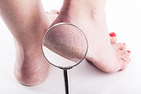 What Factors Play a Role in the Development of Cracked Heels